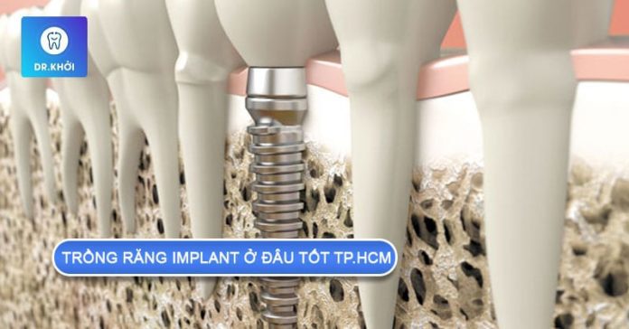 trồng răng implant ở đâu tốt tphcm